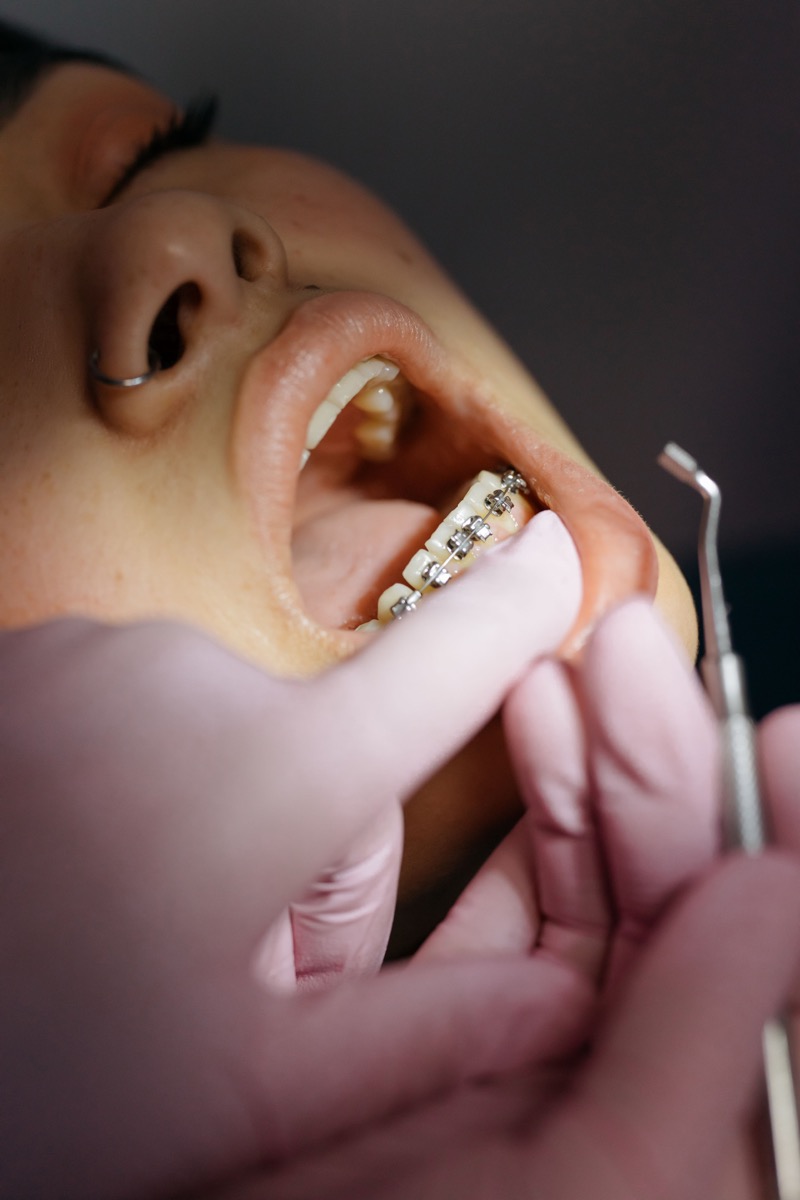 Illustrative close-up of an orthodontic appointment with braces